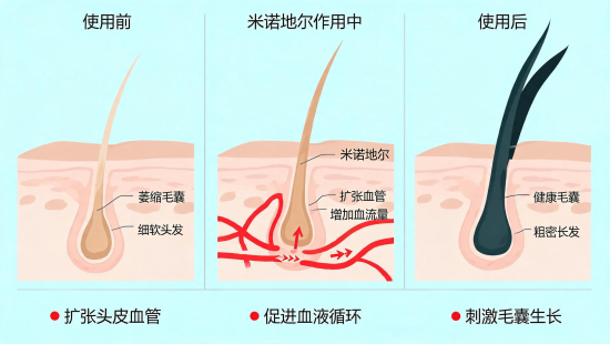 雄激素性脱发发病机制与改善方法