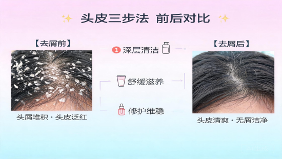 换季头屑多到崩溃试试这个三步去屑法
